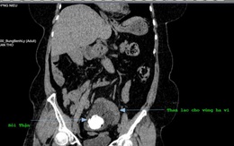 Một bệnh nhân bị sỏi thận lạc chỗ xuống hố chậu