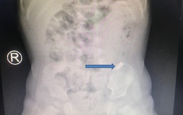 Mảnh kiếng vỡ chạy lung tung trong bụng bé trai 10 tháng tuổi