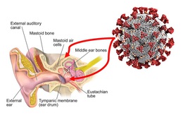 Virus SARS-CoV-2 có thể tấn công tai trong của bệnh nhân