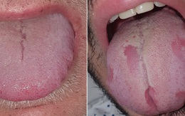 'Lưỡi Covid', triệu chứng mới của đại dịch