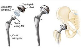 Khớp háng nhân tạo - cứu cánh giúp bệnh nhân gãy cổ xương đùi tránh tàn phế