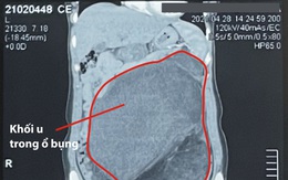 Phẫu thuật lấy khối u khổng lồ trong bụng