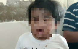 Bé gái 4 tuổi nhập viện với nhiều vết thương: Công an làm việc với dì ruột