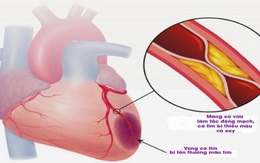 Thông tin cần biết về nhồi máu cơ tim cấp