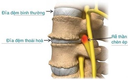 Mới ngoài 20 phát hiện thoái hóa đĩa đệm