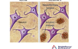 Nghiên cứu mới: Nhiễm vi rút dễ bị bệnh thoái hóa thần kinh
