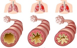 Ho, đờm, khò khè, khó thở: nguyên nhân, chẩn đoán và phòng ngừa