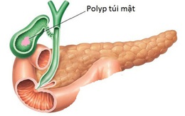 Chủ quan polyp túi mật lành tính, cẩn thận nguy hiểm