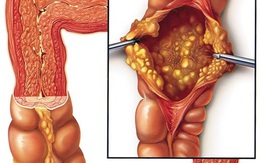 Lạm dụng kháng sinh cẩn thận viêm đại tràng giả mạc