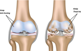 Đứt bán phần dây chằng chéo trước và sụn chêm ở người bệnh thoái hóa khớp gối