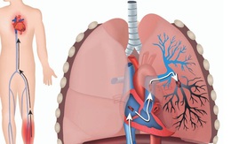 Cẩn thận bệnh 'sát thủ ẩn mình' thuyên tắc động mạch phổi gây tử vong nhanh trong 1-2 giờ