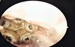 Nữ bệnh nhân nhập viện vì đau tai, bác sĩ gắp ra 5 con giòi sống