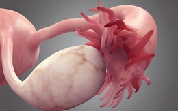 Phát hiện mới giúp nâng cao chẩn đoán và điều trị ung thư buồng trứng