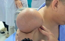 ‘Gỡ bỏ’ khối u vai khổng lồ