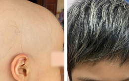 Bé gái 7 tuổi bị rụng hết tóc được điều trị thành công