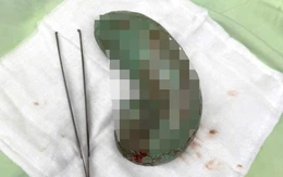 Phẫu thuật thành công cho bé gái ở An Giang nuốt kẹo cao su lâu ngày gây tắc dạ dày