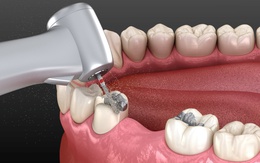 Nhiều nước kêu gọi cấm vật liệu trám răng chứa thủy ngân trước năm 2030