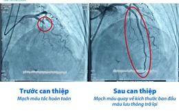 Bệnh viện Tâm Trí Cao Lãnh cứu sống 5 ca nhồi máu cơ tim cấp trong giờ vàng