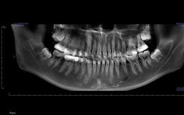 Bác sĩ hướng dẫn tránh sai lầm sau nhổ răng khôn - 'vị khách' đến muộn nhiều phiền toái