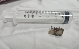 Bỗng dưng mất 2 chiếc răng, 20 năm sau bác sĩ phát hiện trong... phổi