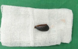 Ho nhiều cả năm, đi khám bất ngờ biết hạt hồng xiêm mắc trong phế quản