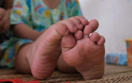 TP.HCM: Tác nhân EV71 tái xuất, ca mắc tay chân miệng nặng tăng