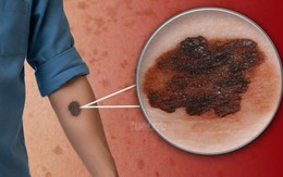 Chuyên gia chỉ cách nhận biết dấu hiệu ung thư da qua nốt ruồi