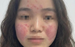 Cô gái trẻ đỏ rát mặt vì ô nhiễm không khí, bác sĩ hướng dẫn cách bảo vệ da
