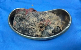 Lấy 0,5kg tóc trong dạ dày cháu bé 6 tuổi ở Quảng Ngãi