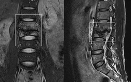 Đau thắt lưng, người đàn ông sững sờ khi phát hiện lao đốt sống