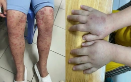 Cảnh báo bệnh ban xuất huyết Schonlein - Henoch gây biến chứng thận nguy hiểm ở trẻ em