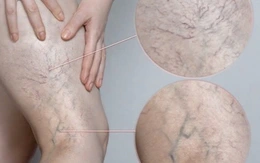 Chân đau nhức, mạch máu lộ rõ cảnh báo bệnh lý đang đe dọa 1/3 người trưởng thành