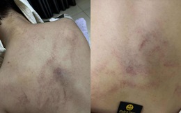 Gia đình tố cô giáo mầm non đánh, kéo lê, ném bé gái 4 tuổi vào tường