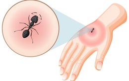 Thực hư chuyện dùng kiến để xua đuổi muỗi truyền bệnh chikungunya