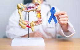 5 dấu hiệu ung thư đại tràng phổ biến thường bị bỏ qua