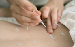 Viện Y tế Quốc gia của Mỹ: châm cứu hiệu quả với đau lưng mạn tính
