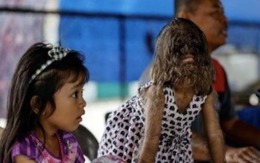 Bé gái Malaysia mắc 'hội chứng người sói' dần thích nghi với môi trường mẫu giáo