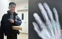 Kèm con học bài, bố nhập viện vì gãy tay sau cú đập bàn