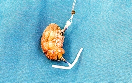 Lấy được vòng tránh thai nhiều sỏi bám do ‘đi lạc’ vào bàng quang sau 22 năm đặt