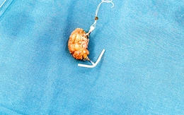 Lấy được vòng tránh thai nhiều sỏi bám do ‘đi lạc’ vào bàng quang sau 22 năm đặt