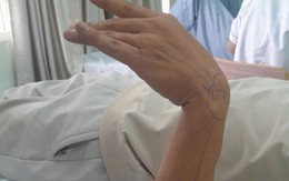 Ngủ gật gối đầu lên tay, người đàn ông 37 tuổi bị liệt thần kinh quay