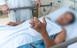 Số ca nhập viện do rắn cắn tăng mạnh, có ca nôn ra máu sau 20 phút bị cắn