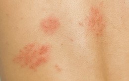 Da đã lành, cơn đau sau zona thần kinh vẫn gây mất ngủ, trầm cảm