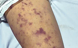 Xã Thường Tân, TP.HCM thông báo ghi nhận ca mắc não mô cầu ở trẻ 12 tuổi