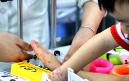TP.HCM ghi nhận hơn 42.000 ca tay chân miệng, 4 tuần liên tục vượt ngưỡng trung bình 5 năm