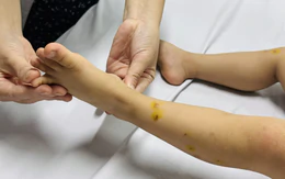 TP.HCM ghi nhận hơn 44.000 ca tay chân miệng, nhiều ca dương tính vi rút EV71 gây bệnh nặng