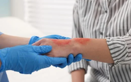 Cách xử trí những tình huống thường gặp ngày Tết, chuyên gia khuyến cáo tránh xa 'mẹo'