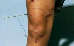 Vụ bé gái bị rạch nhiều vết trên người: Giao 'thủ phạm' cho gia đình, nhà trường quản lý, giáo dục