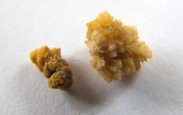 Nhóm đạo chích đột nhập nhà tổng biên tập, tưởng trộm được vàng, không ngờ lấy nhầm sỏi thận