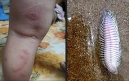 'Bé 3 tuổi bị rết biển cắn cần máu hiếm' gây 'bão' chia sẻ: Hóa ra là tin vịt